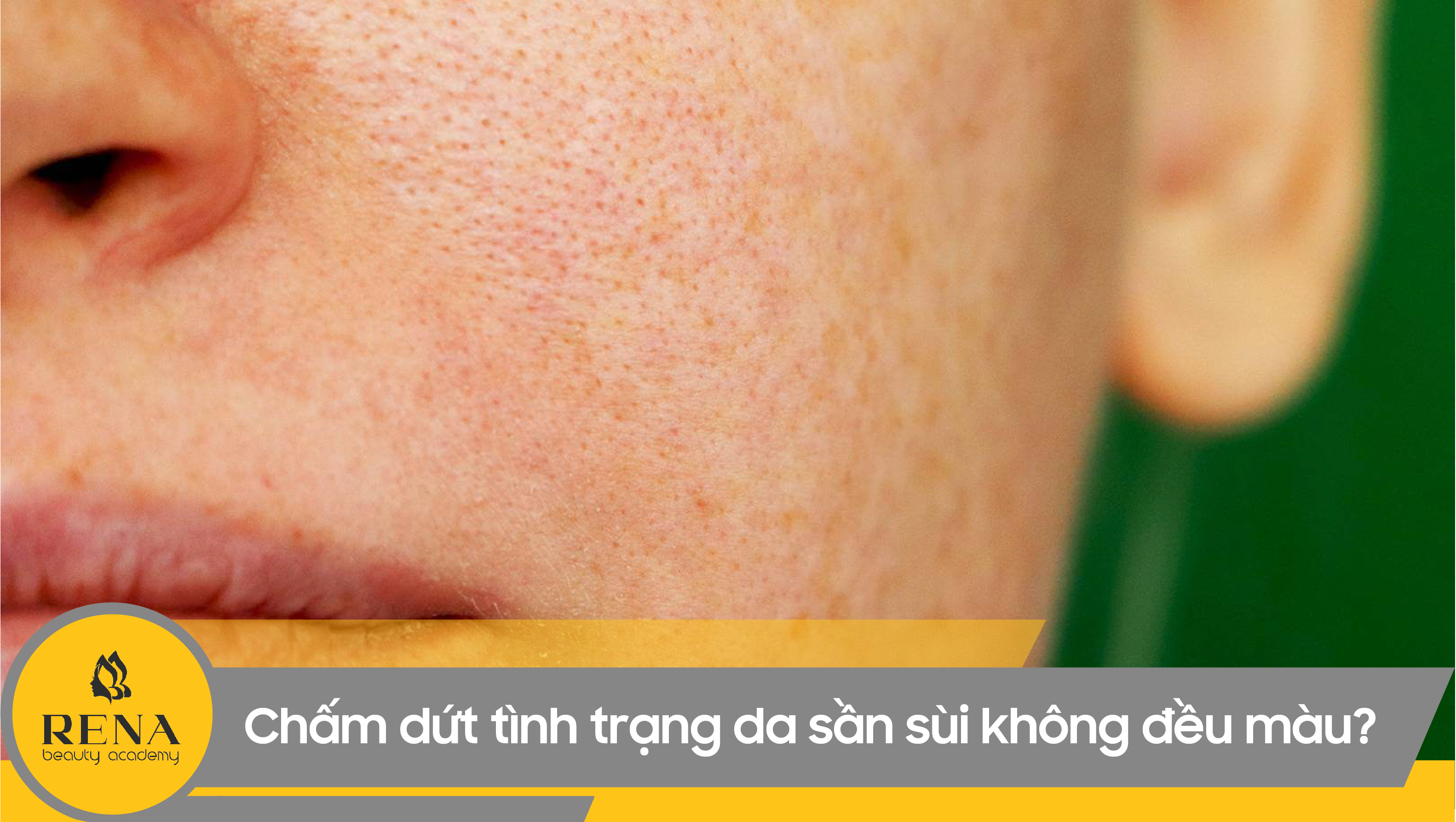 Làm thế nào để chấm dứt tình trạng da sần sùi không đều màu?