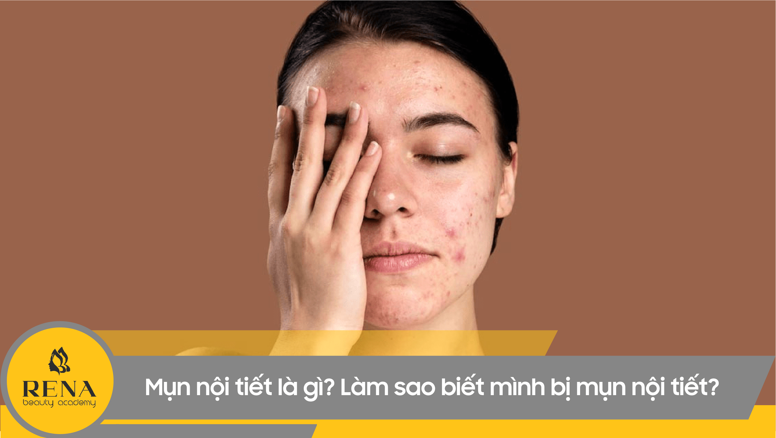 Mụn nội tiết là gì? Làm sao biết mình bị mụn nội tiết?