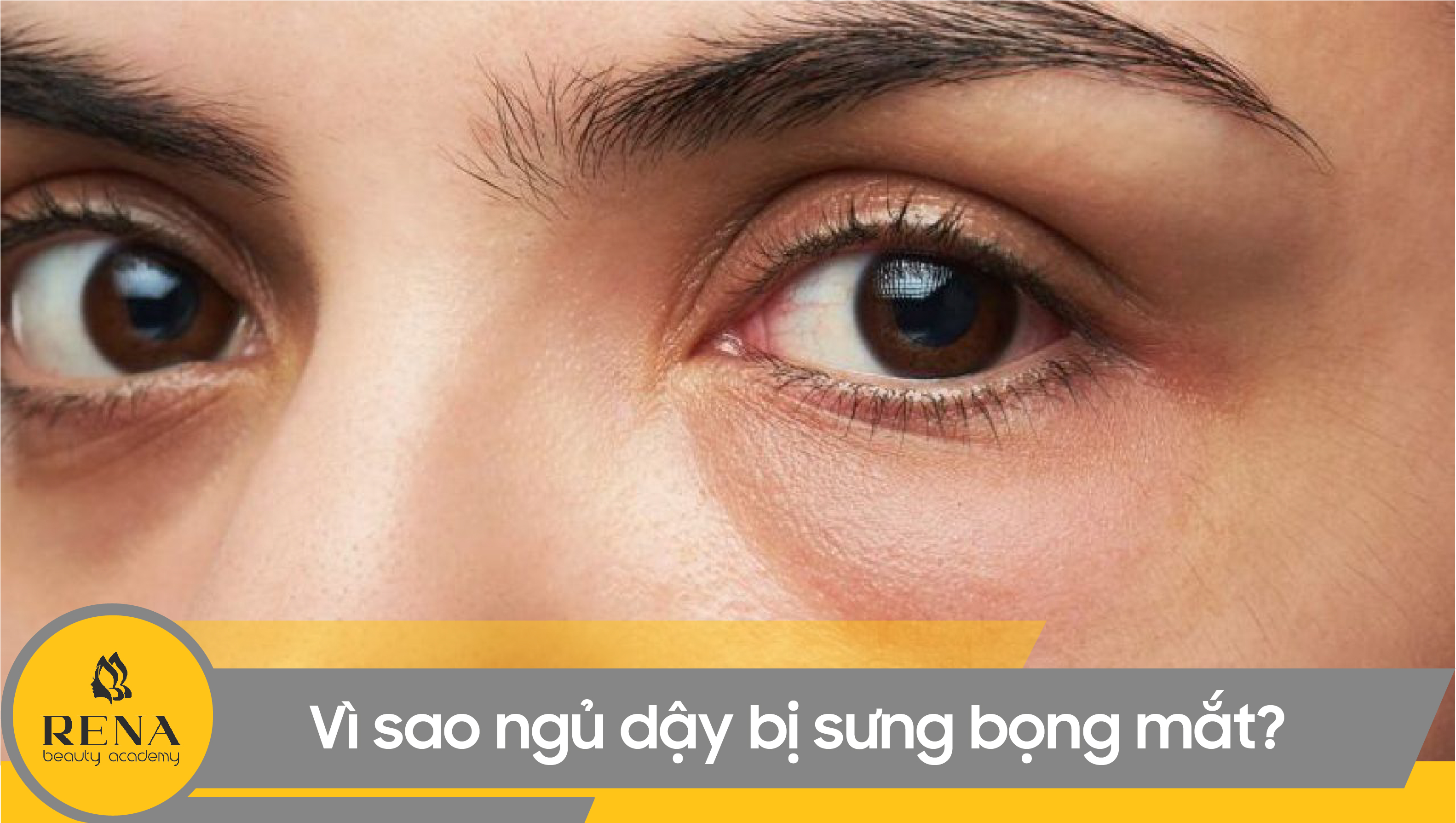 Vì sao ngủ dậy bị sưng bọng mắt? Mách bạn cách chữa cực hiệu quả