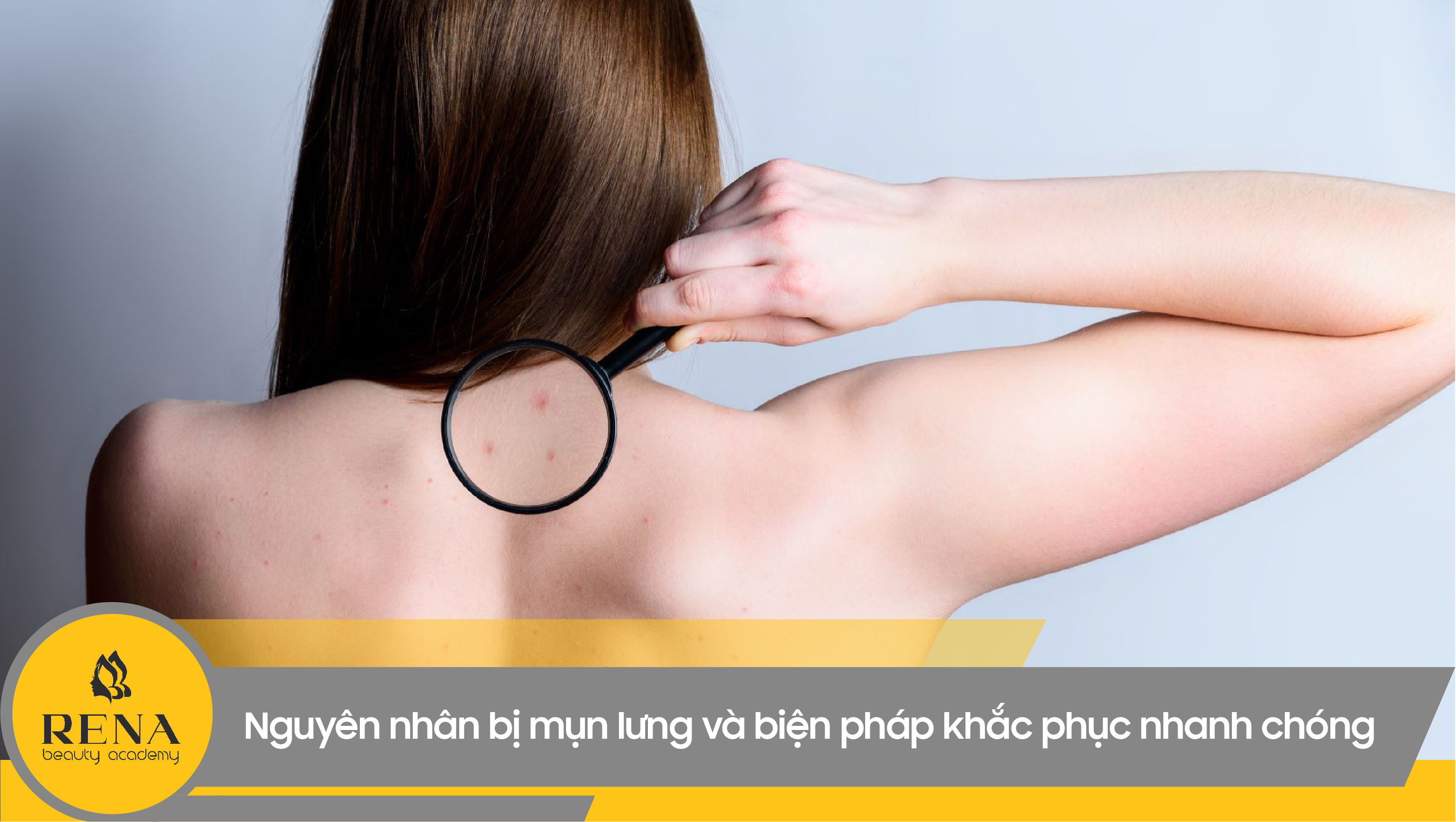 Nguyên nhân bị mụn lưng và biện pháp khắc phục nhanh chóng