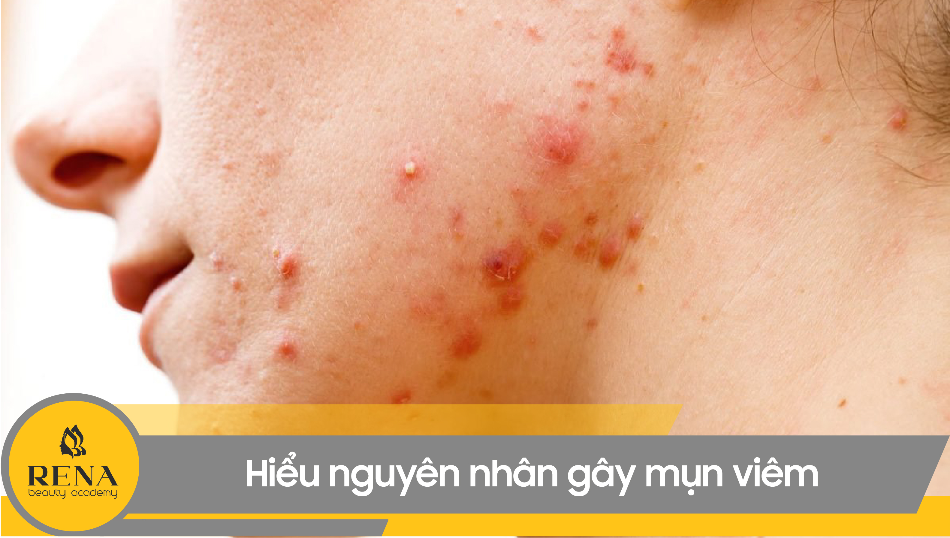 Hiểu nguyên nhân gây mụn viêm, bạn càng dễ điều trị dứt điểm chúng