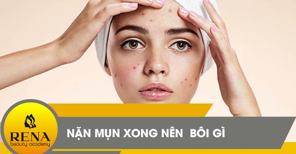 [Mách nhỏ bạn nghe] Nặn mụn xong nên bôi gì?